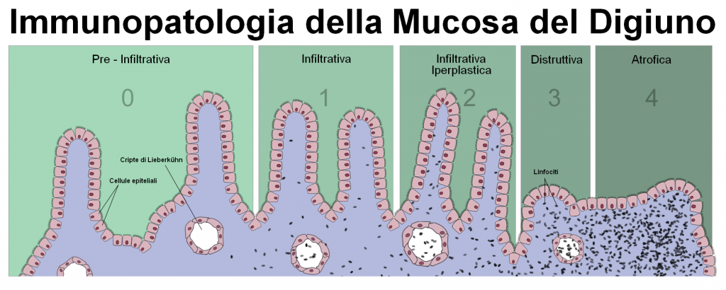 Celiaco o sensibilità al glutine: comprendere le differenze