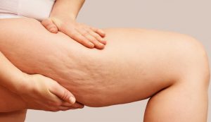 Cosa bere per eliminare la cellulite